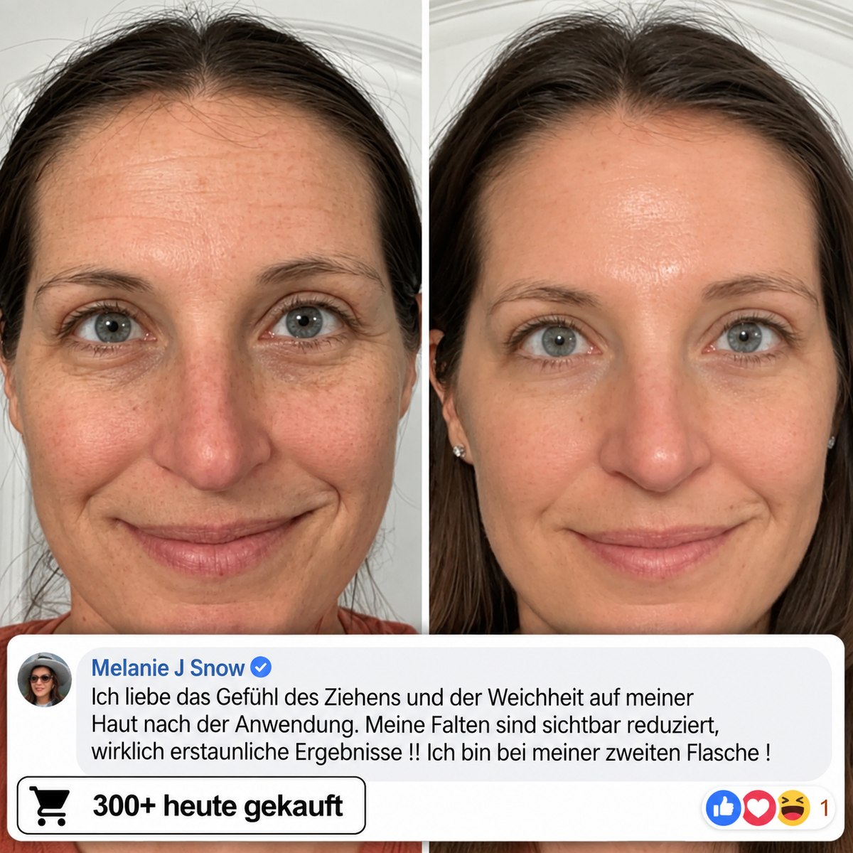 Bio-Kollagen-PDRN-Aufpolsterungsstift