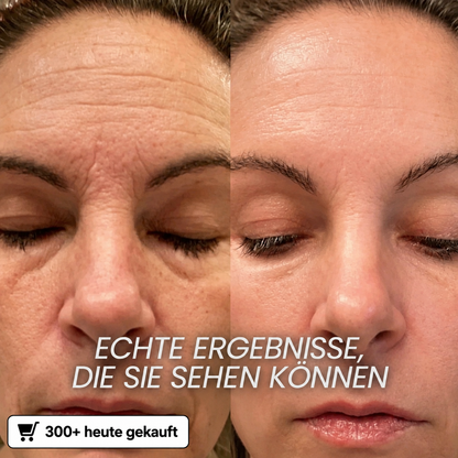 Bio-Kollagen-PDRN-Aufpolsterungsstift